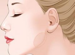 廣州下頜削骨整容整形要多少錢?影響下頜骨截骨術需要多少錢的因素有哪些?