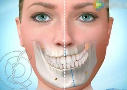 正頜骨手術有什么后遺癥? 正頜骨手術后需要注意什么?