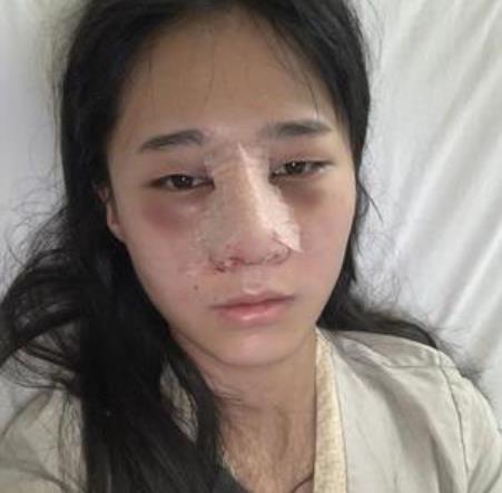 上海時(shí)光整形外科醫(yī)院隆鼻案例_果圖和價(jià)格表在線一覽