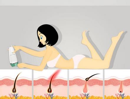 激光脫毛沒(méi)問(wèn)題嗎?激光脫毛可以一次脫完嗎?