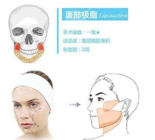 雙下巴吸脂多少錢?雙下巴吸脂有嗎?
