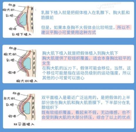 硅膠假體隆胸的注意事項有哪些？隆胸前的準備匯總盤點