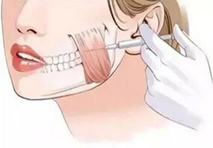 咬肌切除術(shù)是怎么做的?咬肌切除術(shù)的術(shù)后護理要注意什么?