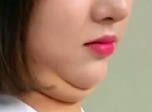 廣州雙下巴抽脂減肥價(jià)格?雙下巴吸脂術(shù)后的護(hù)理要注意什么?