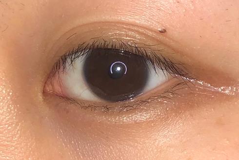 武漢開內(nèi)眼角會回縮嗎?為什么開內(nèi)眼角手術(shù)后眼角縮回?