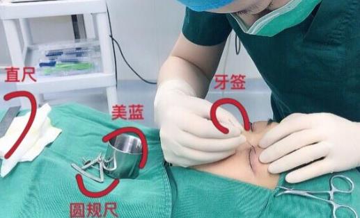 切開雙眼皮手術(shù)前需要什么工具畫線？是*的嗎?