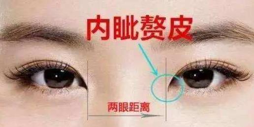 科普篇|內(nèi)眼角修復(fù)難在哪兒?哪些情況需要修復(fù)?注意教你正確選擇