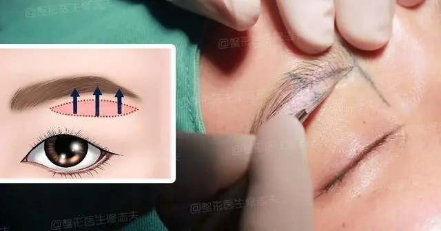 提眉術的目的是什么?提眉術能的六種果匯總