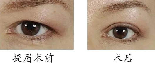微創(chuàng)提眉術和縫合提眉術哪個好?免縫合提眉怎么做的?