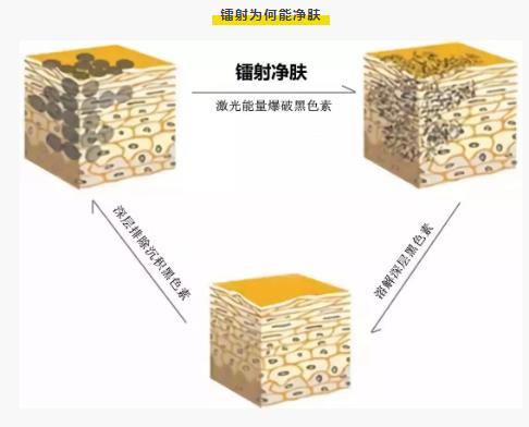 關(guān)于鐳射凈膚的哪些事情總結(jié)！看完消除你對它的誤解