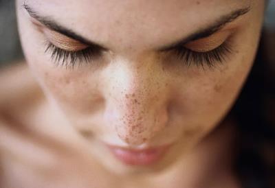 科普篇丨激光去斑后還會(huì)反彈嗎?想一步到位？術(shù)后護(hù)理很關(guān)鍵！??！