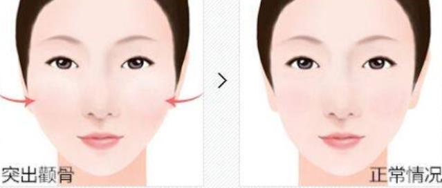 史上較全顴骨內(nèi)推答疑|原理？?jī)r(jià)格？副作用？注意事項(xiàng)？