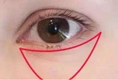 眼袋吸脂怎么做?為什么眼袋吸脂不會(huì)反彈?同