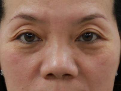 眼袋整形手術多少錢及眼袋整形手術沒問題嗎?