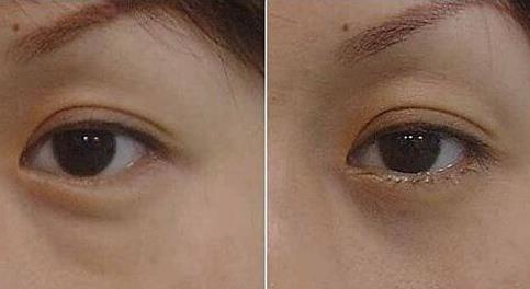 眼袋整形手術價格?眼袋整形手術沒問題嗎?