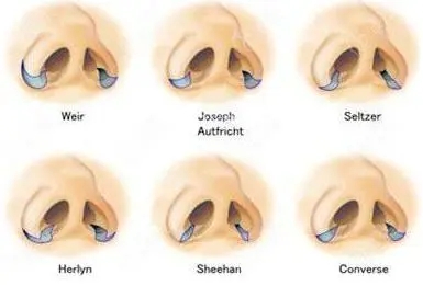鼻翼縮小適合誰?如何讓鼻孔看起來不那么大?