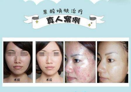 果酸嫩膚祛痘的原理是什么?