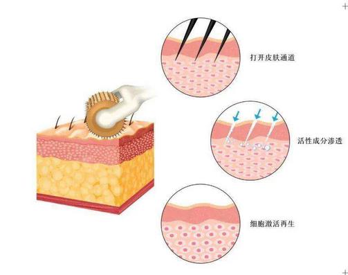 微針除疤幾次見，如何護(hù)理?