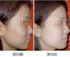 美白能不能自己打？美白前的注意事項(xiàng)