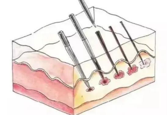 微針和水光補(bǔ)水有什么不同?千萬別選錯!