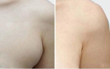 副乳切除術(shù)后的護理要點，多久可以抬手臂?