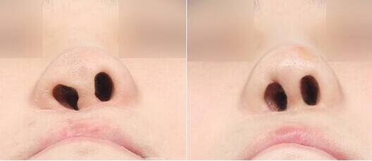 唇腭裂調(diào)節(jié)是越早越好嗎?唇腭裂修復什么時候做?