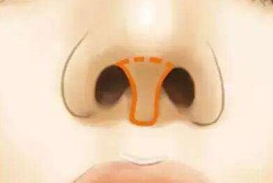 哪些鼻小柱畸形需要手術(shù)矯正，快看看你是不是