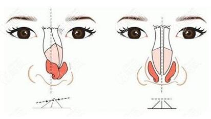 鼻部再造的修復方法有哪些?有什么特點?