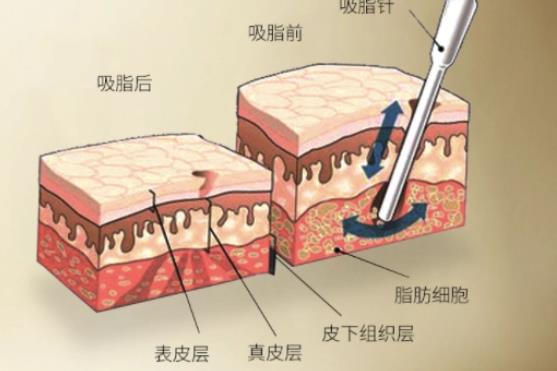 水動力吸脂對身體有沒有影響呢?真相在這里!!！