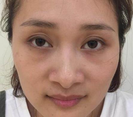 去眼袋手術(shù)有風(fēng)險(xiǎn)嗎?真實(shí)內(nèi)幕我豁出去了!