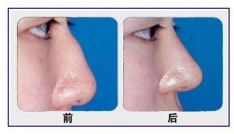 輕中重度駝峰鼻的矯正方法