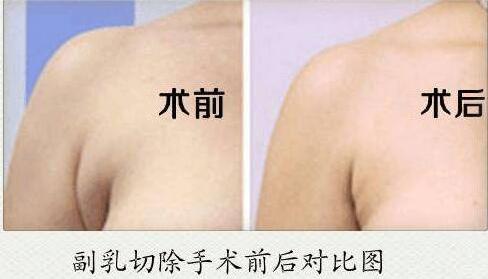 導(dǎo)致副乳的原因是什么?危害有哪些?