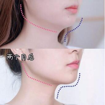雙下巴怎么瘦?光纖和溶脂哪個(gè)瘦雙下巴好?