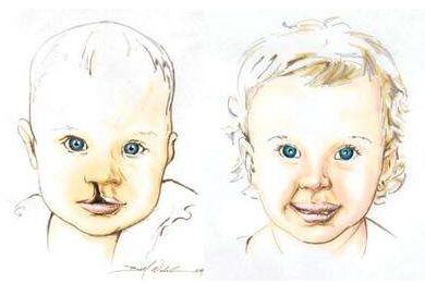 唇腭裂修復術(shù)有哪些并發(fā)癥?唇腭裂手術(shù)后需要注意什么?