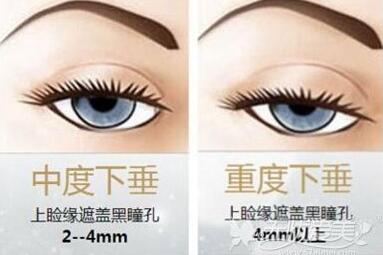 上瞼下垂矯正手術流程詳解