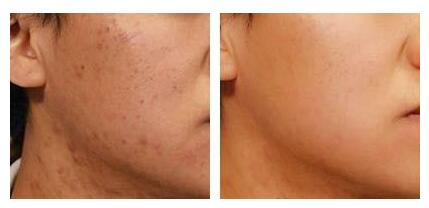 激光去痘印果，多久做一次點陣激光較好呢