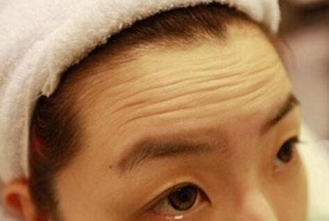 注射瘦臉和玻尿酸去抬頭紋哪個好