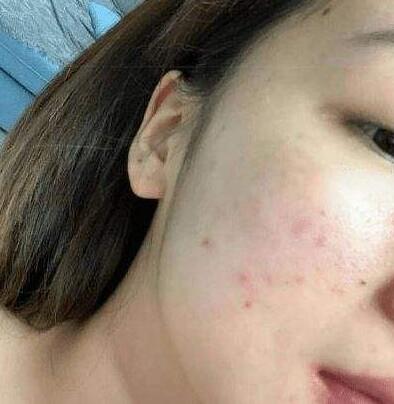 激光去痘印的間隔時間，以及恢復過程