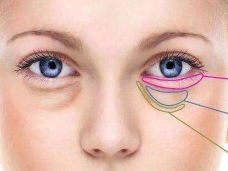 如何消除眼袋?如何消除眼袋?