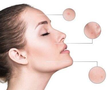 激光去除痘印的缺點有哪些