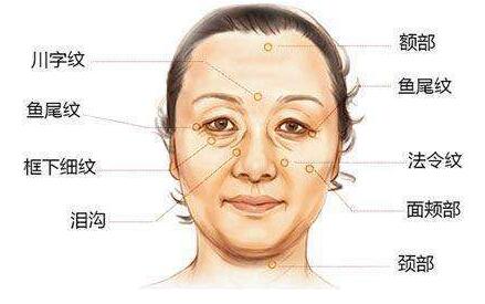 填充法令紋后笑會僵硬的原因
