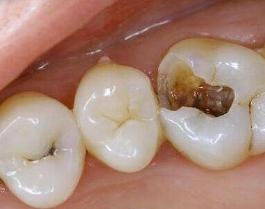 補(bǔ)牙洞是否需要打麻藥呢