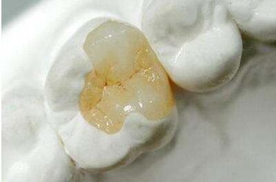 補(bǔ)牙材料脫落的原因是什么?