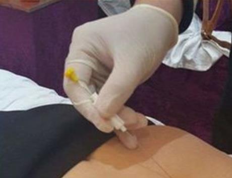 埋線減肥吃辣嗎?哪些人不適合埋線減肥？