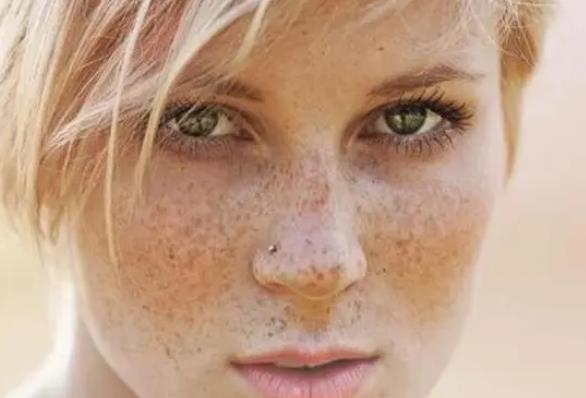 臉上斑點(diǎn)越來(lái)越多應(yīng)該怎么辦？原來(lái)是這有問(wèn)題了!