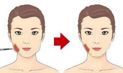 注射瘦臉果的原理是什么?有哪些副作用?