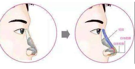 用什么材料來(lái)延長(zhǎng)鼻小柱