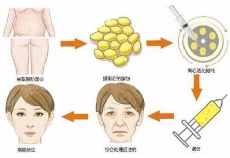 自體脂肪填充整張臉疼嗎?