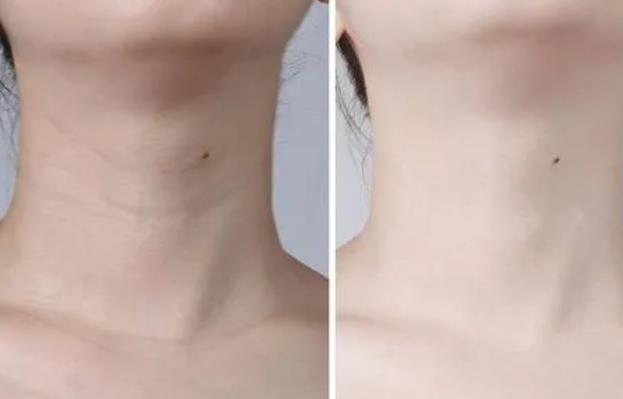 超聲提拉是不是可以去除頸紋？