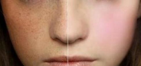 激光祛斑反黑到底會不會恢復呢